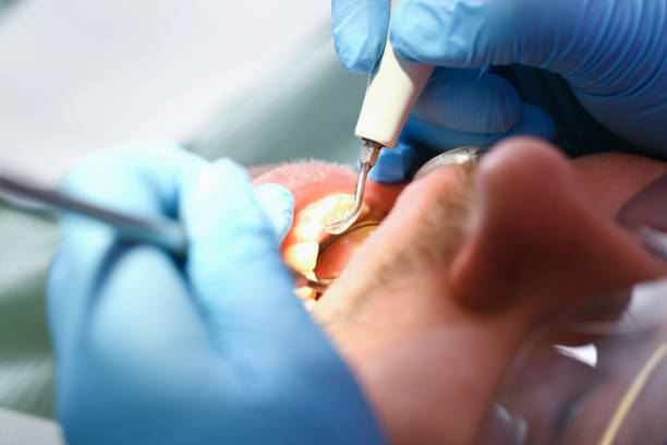 Best Emergency Wisdom Tooth Extraction in Salem, NC